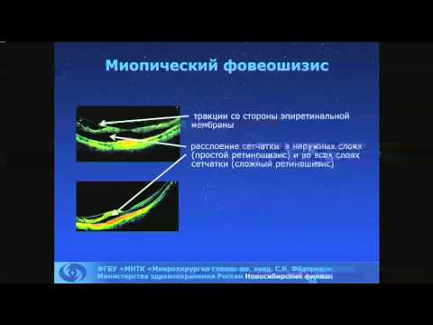 Видео: Дулидова В.В. Миопическая макула. ОКТ-диагностика.