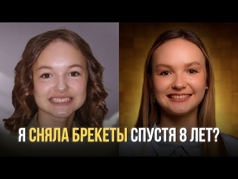 Видео: МОЯ ИСТОРИЯ С БРЕКЕТАМИ | ПОЧЕМУ 8 ЛЕТ?