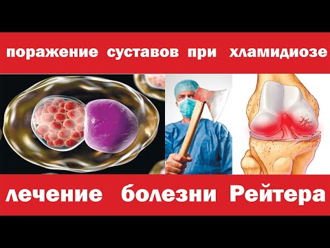 Видео: Боль в коленном суставе. Болезнь Рейтера.Хламидиоз. Как лечить?