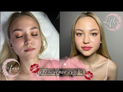 Видео: УВЕЛИЧЕНИЕ ГУБ👄ПЕРВОЕ УВЕЛИЧЕНИЕ ГУБ ВЛОГ👀РЕАКЦИЯ ПАРНЯ😮ЛЕТНИЙ ВЛОГ😏МОЕ УТРО🙂МОЙ ВЕЧЕР🤭