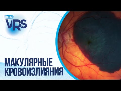 Видео: Макулярные кровоизлияния