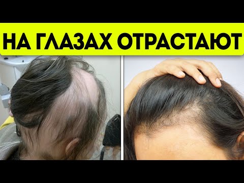 Видео: Капнул, растёр и началось! Как применить репейное масло для волос