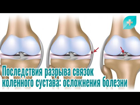 Видео: Последствия разрыва связок коленного сустава: осложнения болезни