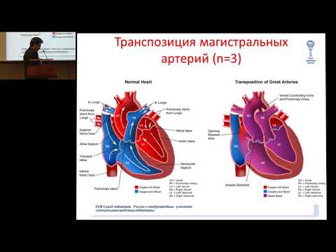 Видео: 19.02.2017 - Критические пороки сердца в периоде новорожденности - мультидисциплинарный подход
