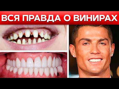 Видео: ВИНИРЫ /  Что такое виниры, насколько они практичны и кому подходят