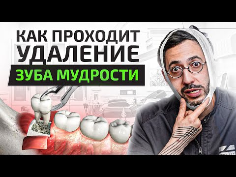 Видео: Как проходит удаление зуба мудрости. Первые 7 дней после удаления