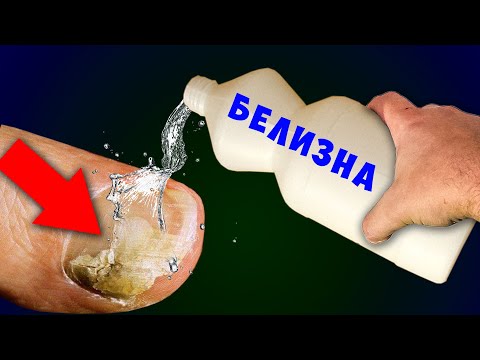 Видео: Как я уничтожил ГРИБОК ногтя Обычной БЕЛИЗНОЙ! Грибок боится этого больше всего