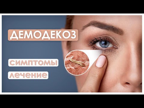 Видео: ДЕМОДЕКОЗ ВЕК / демодекозный блефарит / как избавиться