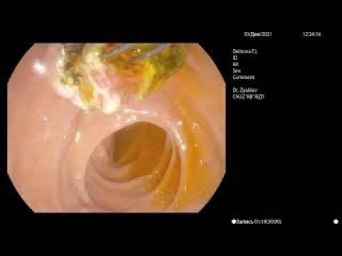 Видео: Удаление камней из желчных протоков. ЭРХПГ.