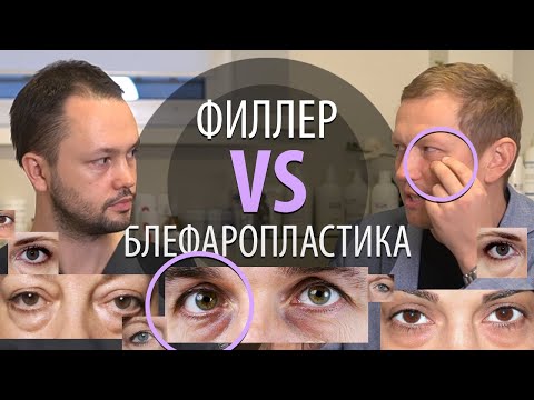 Видео: Мешки под глазами: коррекция носослезной борозды или блефаропластика?