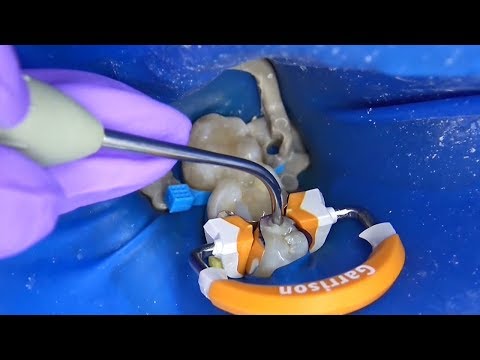 Видео: реставрация жевательных зубов мини версия