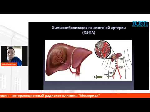 Видео: Шаршебаев Руслан Докдурбаевич - Интервенционная радиология в Кыргызстане