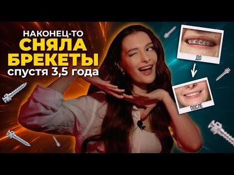 Видео: Честно о БРЕКЕТАХ: 4 ортодонта, микроимпланты и 3,5 ГОДА СТРАДАНИЙ