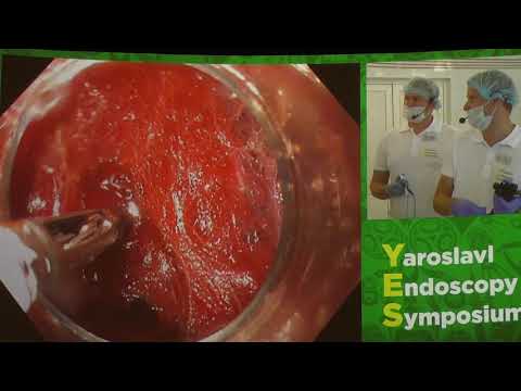 Видео: 04Live Ткаченко ОБ POEM ПОЭМ при ахалазии пищевода OLYMPUS Erbe
