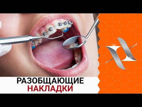 Видео: НАКЛАДКИ с брекетами | Самое страшное в ортодонтии