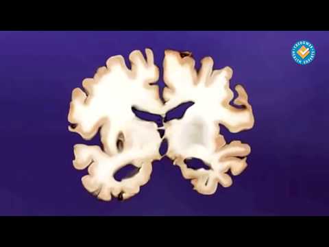 Видео: Мозъчносъдова болест, деменция и "тих" инсулт (ДИСКУСИЯ)