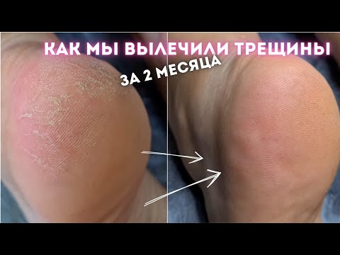 Видео: ТРЕЩИНЫ НА ПЯТКАХ результат после одного педикюра. Плёнки для ногтей Kisa.stickers