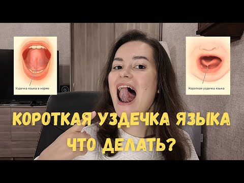 Видео: Короткая уздечка языка! Что делать и чем она опасна?