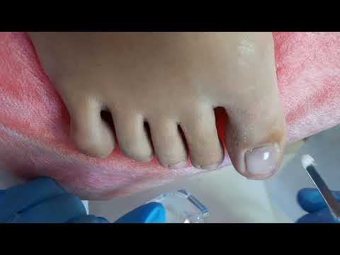 Видео: Протезирование ногтевой пластины - Подолог Елена Баскова