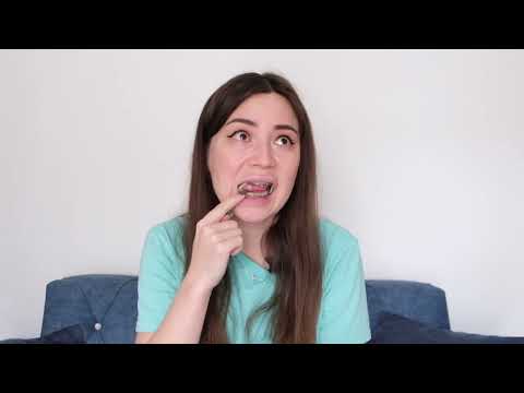 Видео: Брекеты 4 месяца спустя. Эластики и прочие прибамбасы для пыток