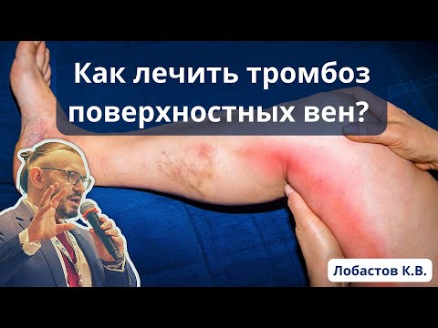 Видео: Доклад: "Как лечить тромбоз поверхностных вен?" (03.06.2023)