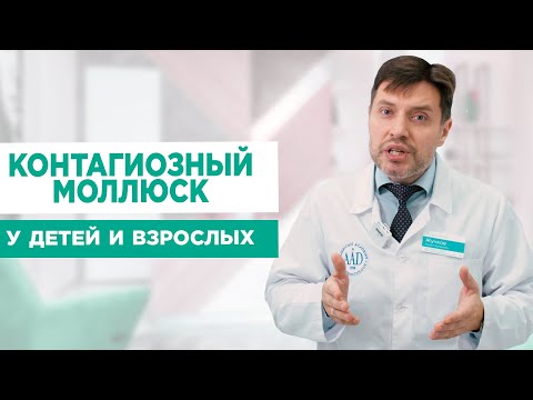 Видео: Контагиозный моллюск: у детей и взрослых. Механизм передачи и методы лечения