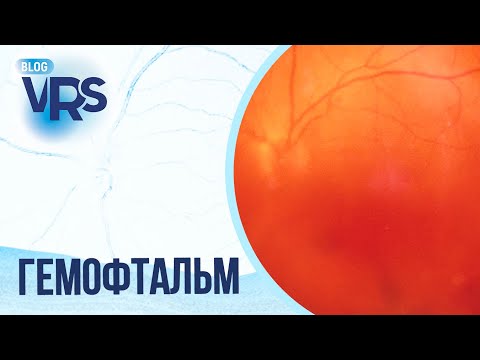 Видео: Сахарный диабет / Диабетическая ретинопатия / Гемофтальм