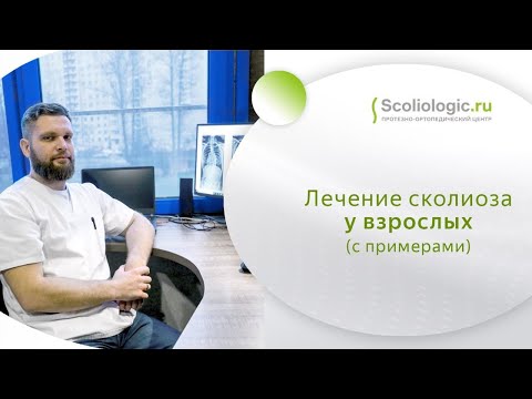 Видео: Промежуточные результаты экспериментальной программы консервативного лечения сколиоза у взрослых