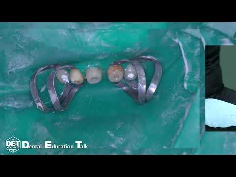 Видео: Распломбировка корневого канала за 8 минут с эндомотором  Eghteeth DET.expert 4K