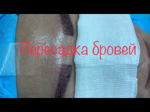Видео: ПЕРЕСАДКА БРОВЕЙ, ТРАНСПЛАНТАЦИЯ ВОЛОС В ЗОНУ БРОВЕЙ
