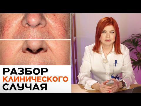 Видео: Избавьтесь от СОСУДОВ на лице! / Как БЫСТРО убрать купероз?