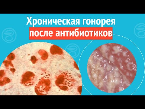 Видео: 🥺 Хроническая гонорея после антибиотиков. Клинический случай №1392