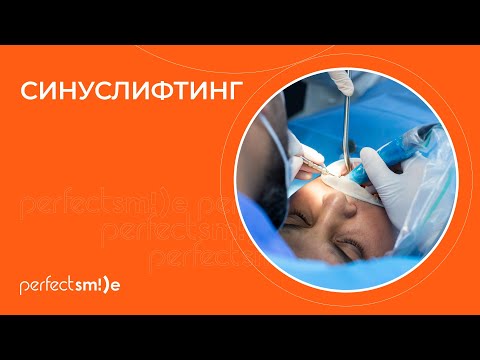 Видео: ✅ Синуслифтинг: что нужно знать о процедуре