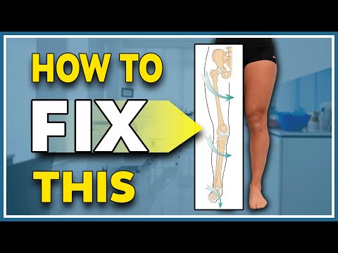 Видео: Самая недооцененная причина боли в колене — эндоторсия надколенника