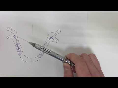 Видео: Мандибулярная анестезия