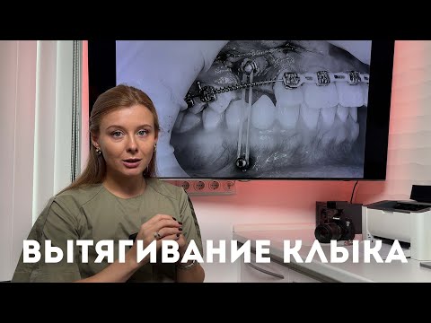 Видео: Вытягивание непрорезавшегося клыка
