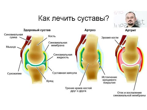 Видео: Как лечить суставы?