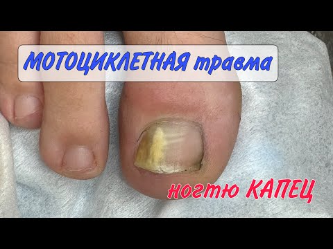Видео: Подногтевой панариций/ жёлтый ноготь/ воспаление под ногтем