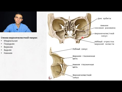 Видео: Гаймориты, гайморотомия по Caldwell Luc