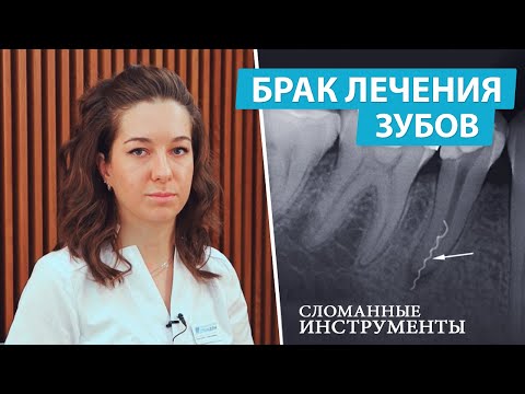 Видео: Удаление сломанных инструментов из канала зуба с помощью микроскопа