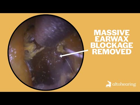 Видео: Он жил с заложенными ушами в течение многих лет. И вот момент, когда они очистились.
