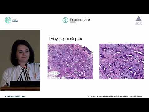 Видео: Патоморфологическое разнообразие рака молочной железы
