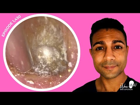 Видео: 1430 - Омертвевшая кожа, пораженная грибком, удалена и отслоена с уха | СМОТРИТЕ НОВУЮ ЛИНЕЙКУ ИН...