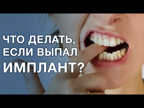 Видео: Что делать если выпал имплант зуба? Шатается имплант зуба.