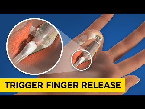 Видео: Как синдром «триггерного пальца» может возникнуть у вас (и как его исправить)