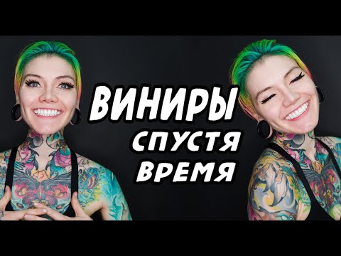 Видео: Виниры. Отзыв спустя время. Моя история