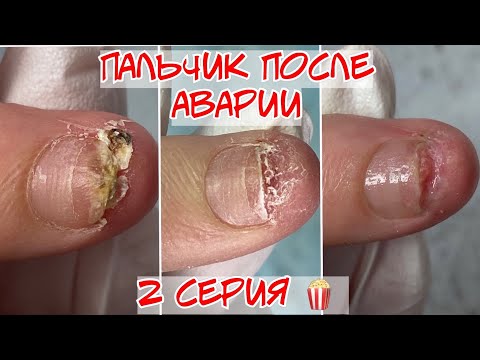 Видео: Преображение ❤️ Как восстановить ноготь после травмы 🔥 2 серия 🔥