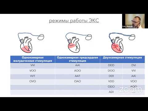 Видео: Интерпретация ЭКГ у пациентов со стимуляторами. ЭКГ картина современных алгоритмов кардиостимулятора