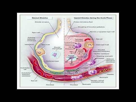 Видео: Дыхательная недостаточность и острый респираторный дистресс синдром (5 часть)