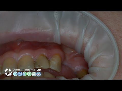 Видео: Резекция верхушки 23 DTE DS-II Led Bone Surgery (прямой эфир)